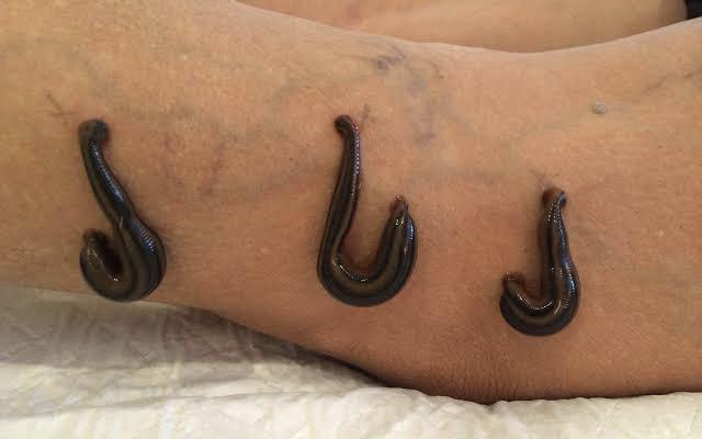 leech-therapy